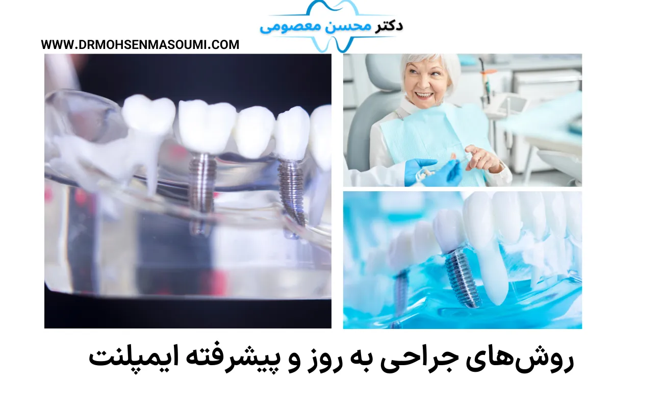 روش‌های جراحی‌ به روز و پیشرفته ایمپلنت