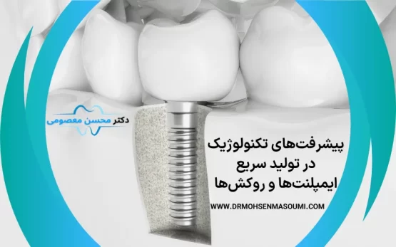 پیشرفت‌های تکنولوژیک در تولید سریع ایمپلنت‌ها و روکش‌ها