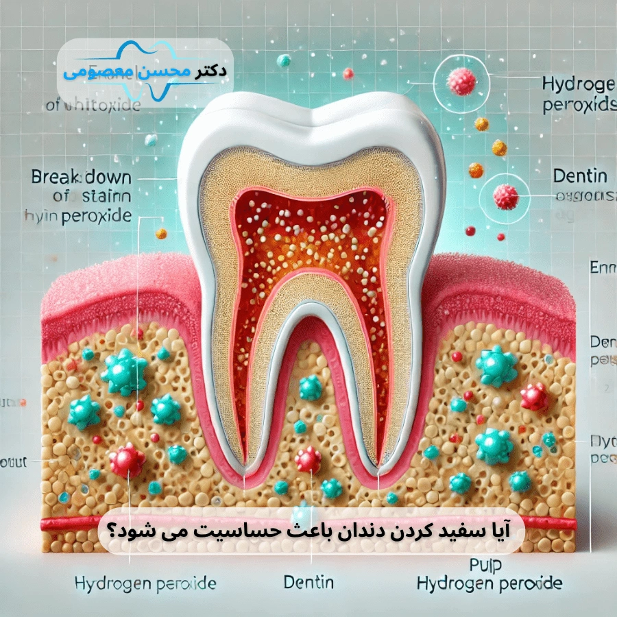 آیا سفید کردن دندان باعث حساسیت می شود؟